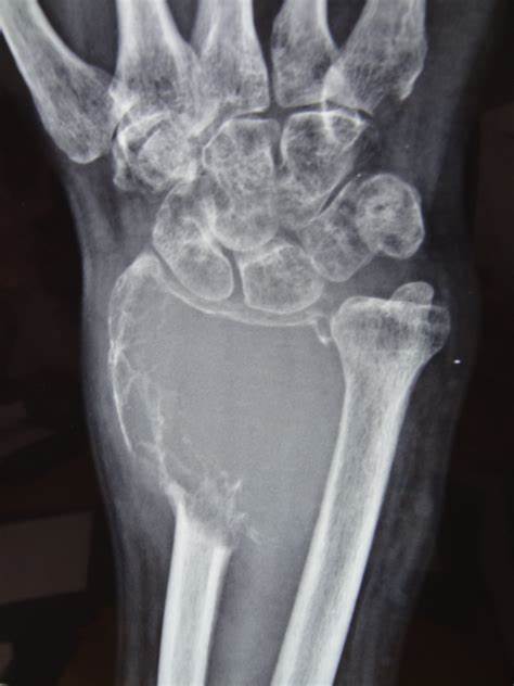 bone_tumor